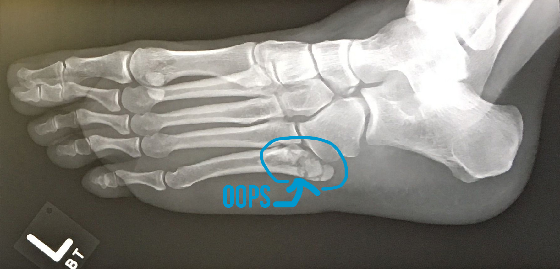 foot xray